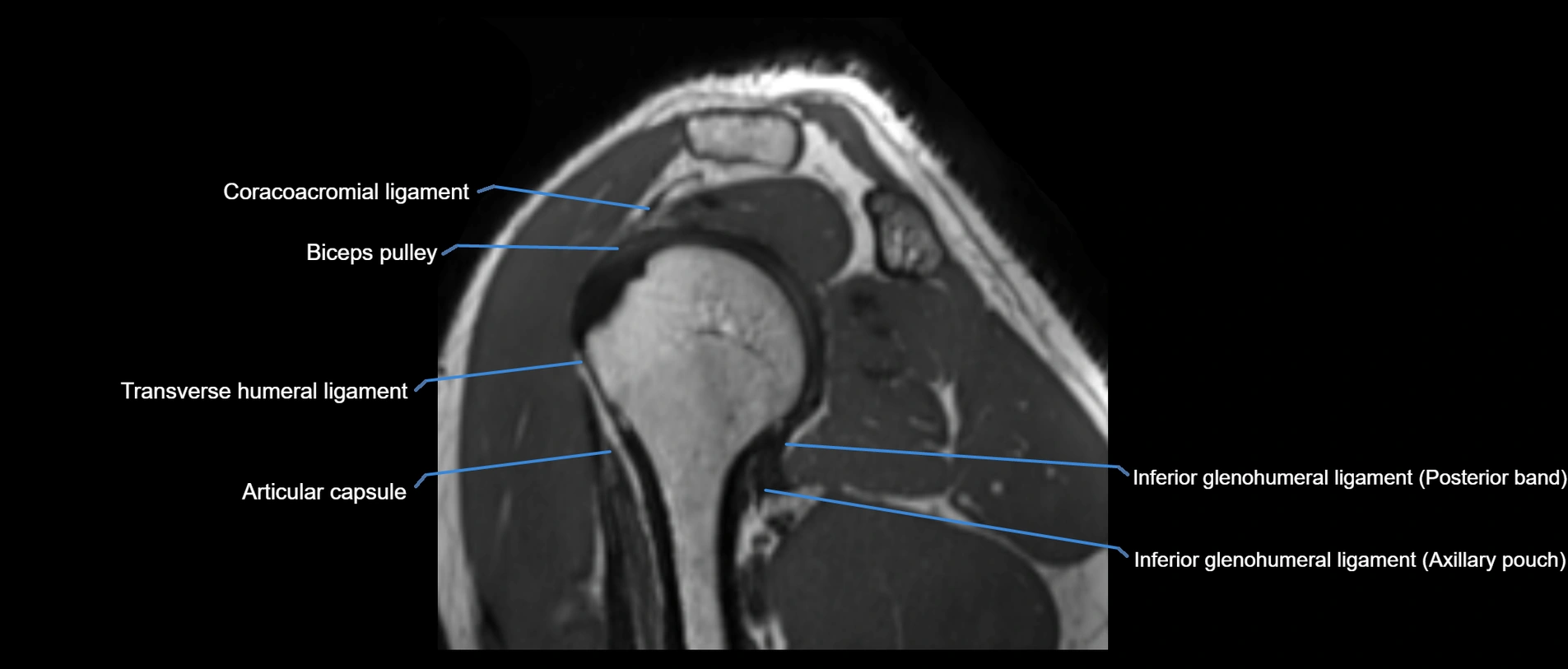 shoulder ligaments sagittal  cross sectional anatomy 3T MRI AI enhanced radiology image -img-00001-00034.webp